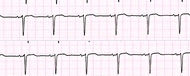 Ritmo sinusale normale     