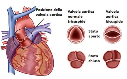 Illustrazione dal documento: insufficienza aortica nuovo