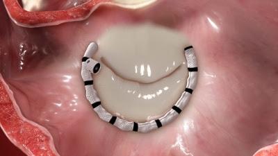 Cardioband posizionato sull’anello mitralico
