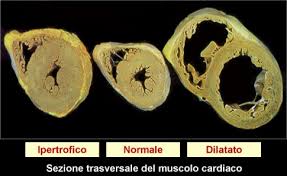 Miocardio ipertrofico, normale e dilatato